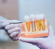 a person holding a model of dental implants