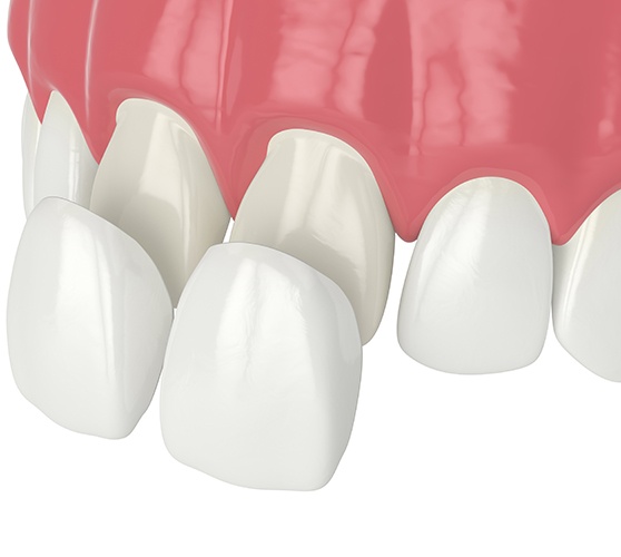 Up-close view of dental veneers