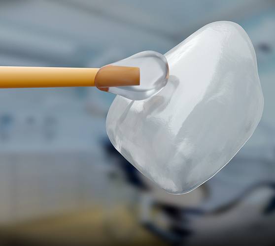 Image of dental veneer preparing for placement