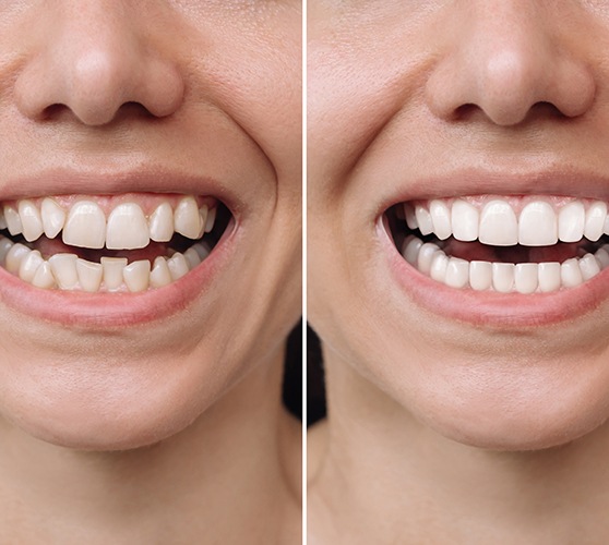 Before and after images of teeth with and without veneers