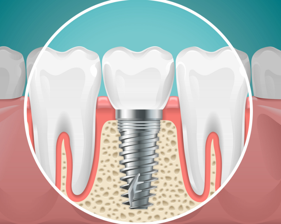 Illustrated cross section of a dental implant